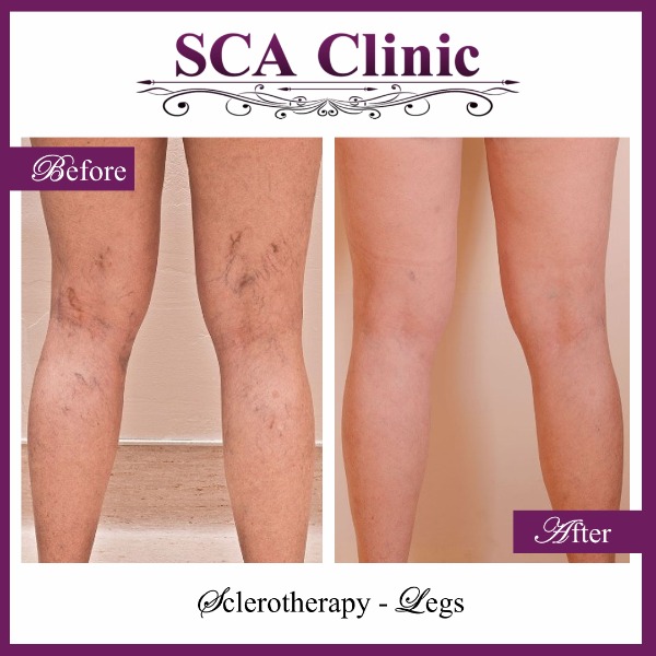 Sclerotherapy - Legs Photo